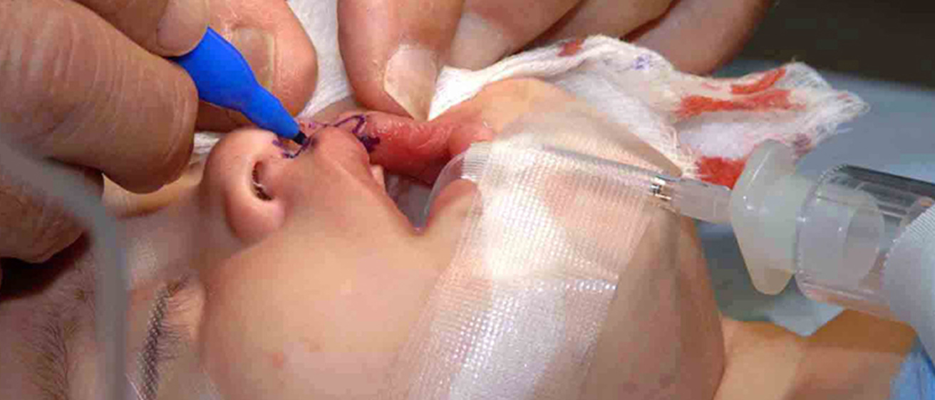 Craniofacial Anomalies